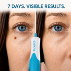 Skin Tag Remover Machine